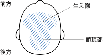 AGAの発症箇所