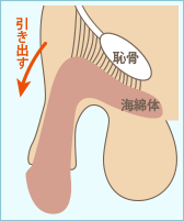 長茎術