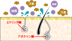 ワキガ多汗症のイメージ画像