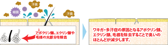 組織削除法のイメージ画像