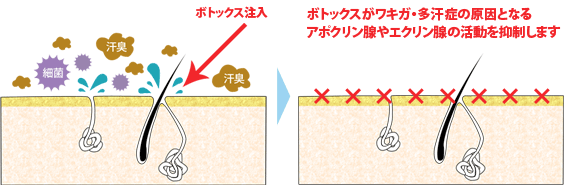 ボトックス注入法のイメージ画像